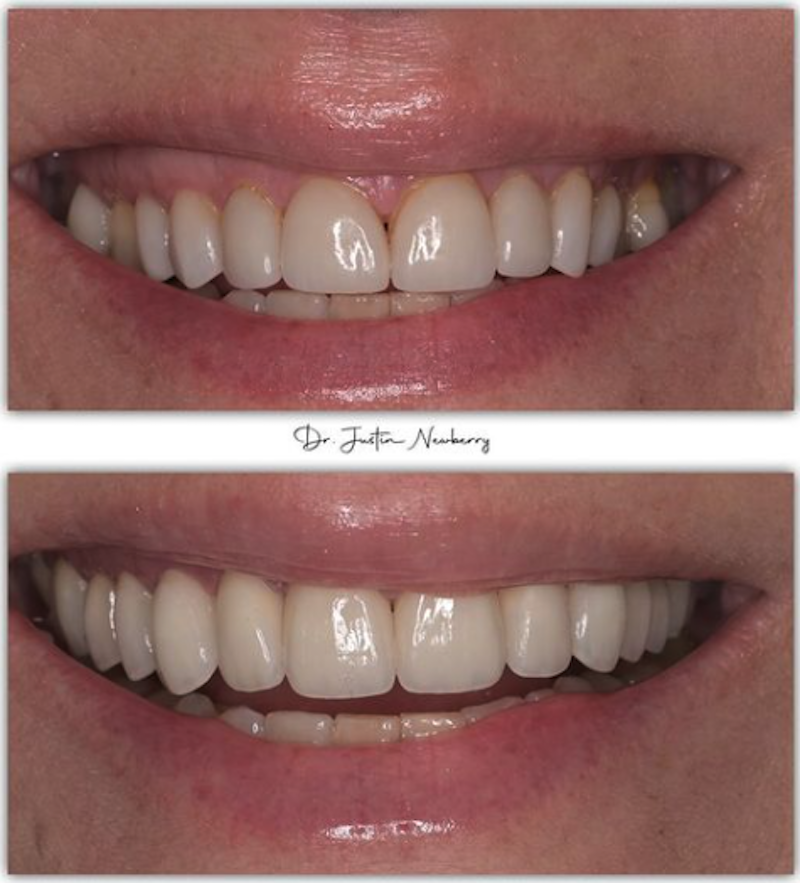 Smile Makeover in Napa