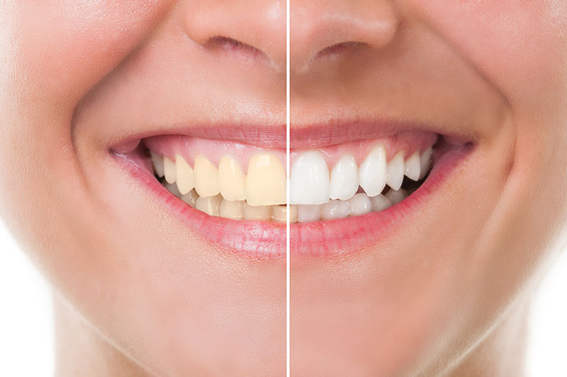 Teeth Whitening in Napa