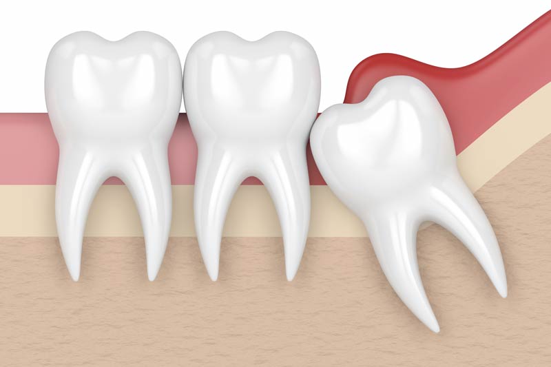 Wisdom Tooth Removal in Napa